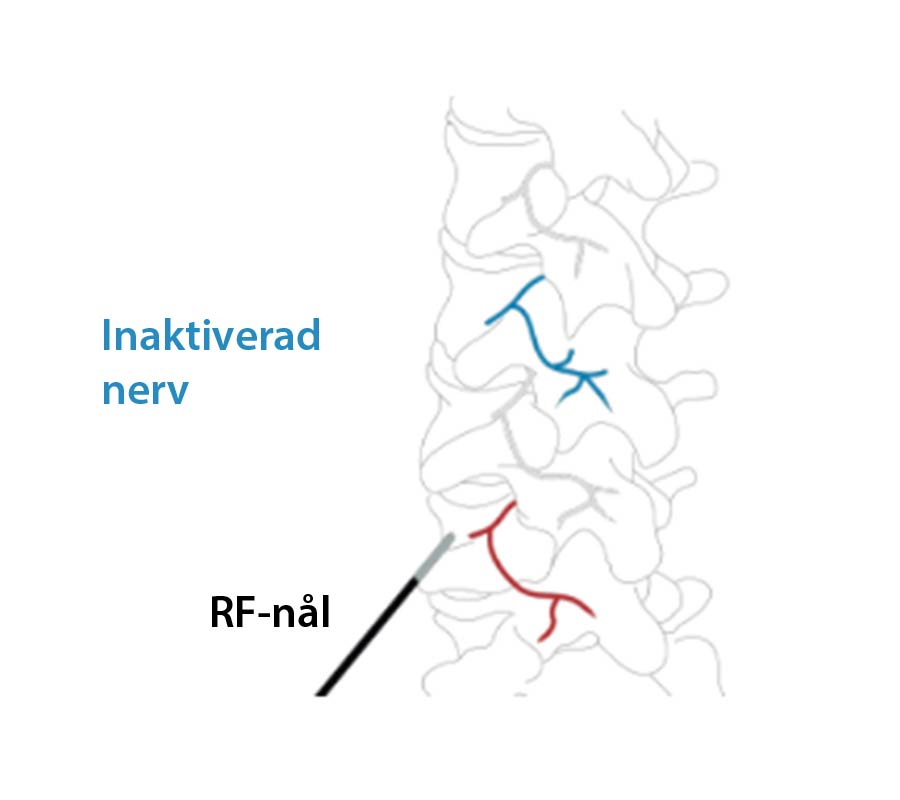 Illustration av hur man går till väga för att inaktivera nerven