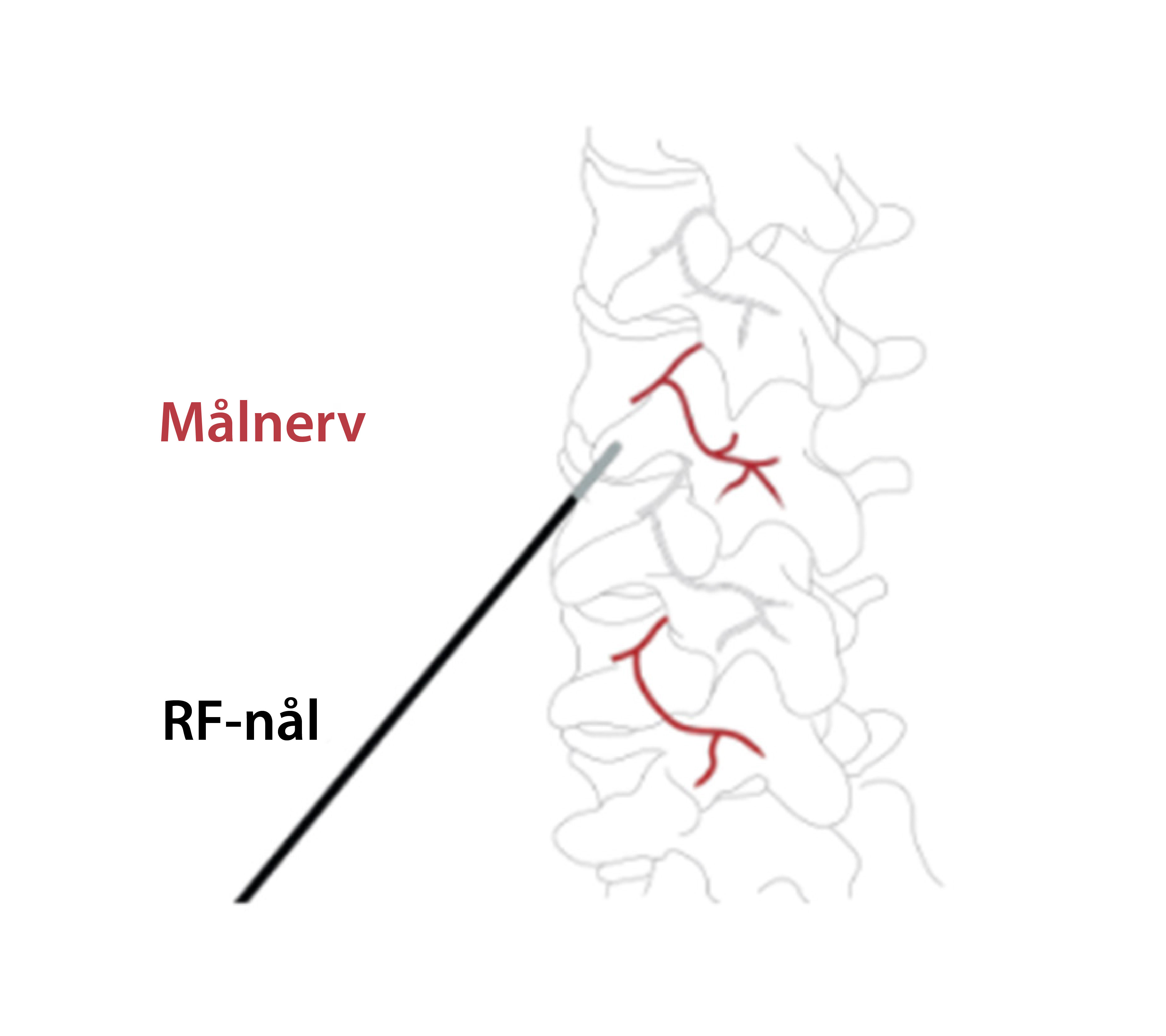 Illustration av riktad behandling av nerv