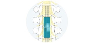 Contour-enheten för ryggmärgsstimulering